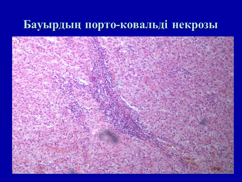 Бауырдың порто-ковальді некрозы